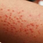 Brote de sarampión: Ssa reporta 23 fallecimientos