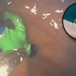 Niño tenía un fuerte dolor y médicos descubren un «Hulk» en el estómago