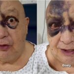 Luis de Alba preocupa tras accidente; reaparece con el rostro cubierto de hematomas